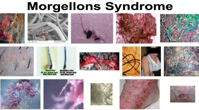 Morgellons was released by US government as a bioweapon